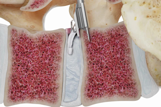 do 3d medical animation 3d medical device animation spine orthopedic animation