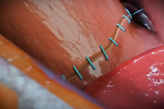 create 3d medical animation, medical surgery, medical animation anatomy