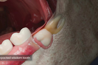 create 3d dental animation, dental procedure, dental implant and oral surgery