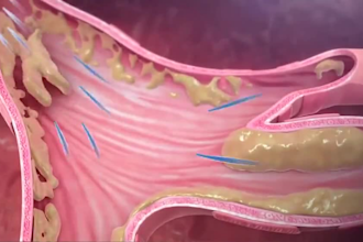 2d 3d medical animation, medical device animation, healthcare, surgical, anatomy