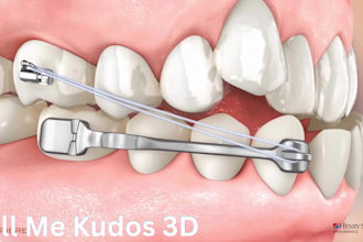 create 3d dental animation, 3d orthodontic extra oral device, medical animation