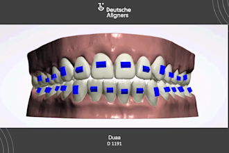 do aligners treatment planning using 3shape orthosystem