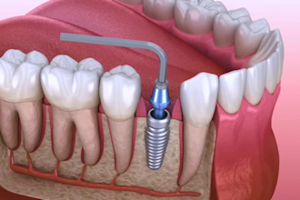 do 3d product animation 3d industrial video 3d medical animation 3d dental video
