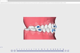 do dental clear aligners treatment planning,setup design on onyxceph software