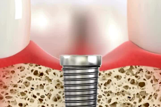 do  3d medical animation surgery animation 3d dental animation dental animation