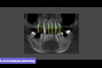 design implant surgical guide and stackable guide in realguide