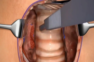 3d medical animation, surgery animation, anatomy video, medical device explainer