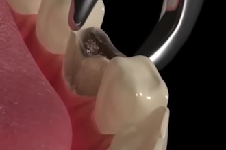realistic 3d dental animation 3d medical animation 3d medical explainer video