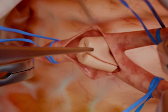 3d medical animation 3d healthcare video 3d medical surgery explainer animation
