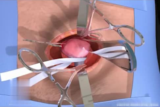3d medical animation 3d medical 3d medical animation video surgery anatomy