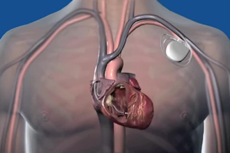 3d medical animation 3d medical device explainer surgery animation 3d medical