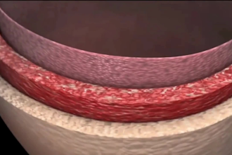 create 3d medical animation surgery animation surgical procedure medical device