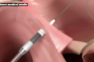 3d medical device animation implant surgery device animate stunning 3d medical