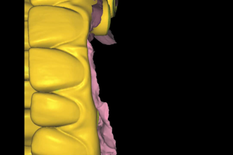 design dental prothesis all on x using exocad