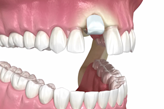 do super quality 3d medical animation video, 3d dental implant with HD rendering