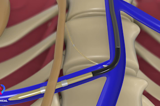 3d medical animation, surgery procedure video, medical device demonstrations