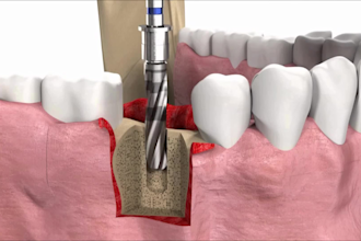 create 3d dental animation 3d medical animation dental implant procedure video