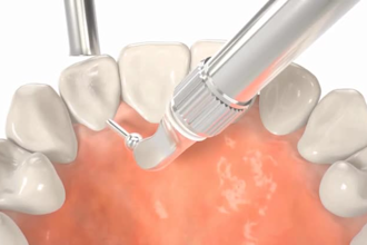do medical animation, 3d procedure video, dental animation, 3d surgery animation