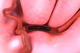do high quality 3d medical animation, surgery animation, 3d medical explainer