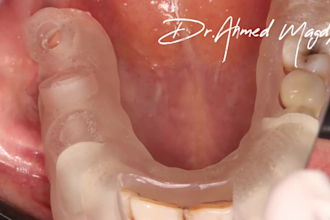 do implant planning, surgical guides, and stackable guides
