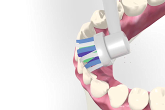 do 3d dental animation and design clear aligner case with 3shape ortho