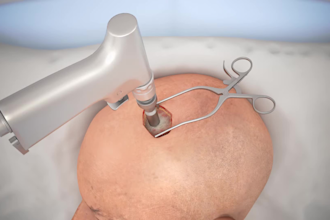 do 3d surgical animation and ventriculostomy brain surgery
