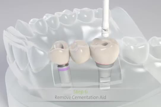 do 3d dental animation video 3d orthodontic dental implant 3d animation video