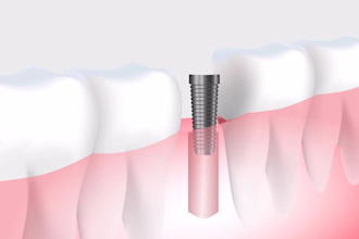 3d medical animation, 3d medical, surgery animation 3d dental animation