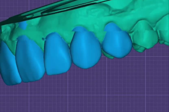 design full arch dental restoration
