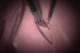 crate 3d medical animation 3d surgry animation illusration and animation