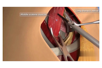 create explainer 3d medical video for 3d surgery animation video