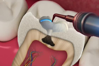 3d dental surgical animation step by step medical procedure videos healthcare