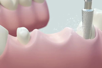 high quality 3d dental animation, aesthetic surgery 3d medical animation video