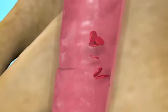 make 3d medical animation, medical animation, surgery animation, medical video