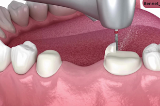 create 3d dental implant procedure medical videos 3d surgical animation visuals