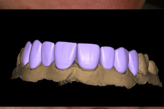 do digital wax up dsd using exocad