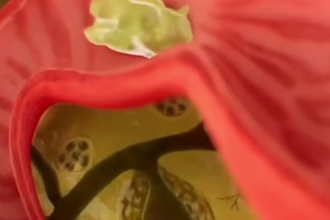 3d medical animation video, biology explainer video, 3d surgical animation