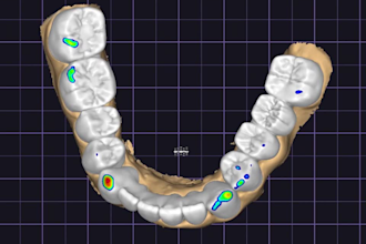 create precise crowns, implants, and dentures using exocad