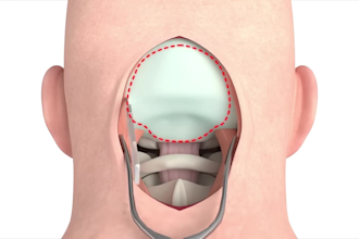 3d surgery animation, anatomy video, medical explainer, and procedure animation