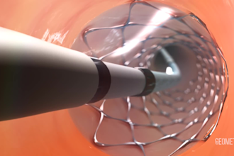 create 3d medical animation 3d explainer video for medical device visualization