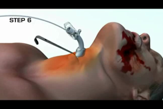 3d medical animation video, 3d surgery animation,  skeletal 3d anatomy animation