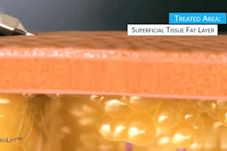 2d 3d medical animation, medical device animation, healthcare, surgical, anatomy