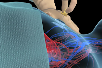 do 3d medical animation chemotherapy implantable port nursing explainer video