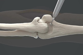 create 3d medical device animation for catheter, stent implant or cardiovascular