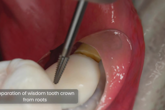 create 3d medical animation, dental surgery animation, 3d anatomy animation