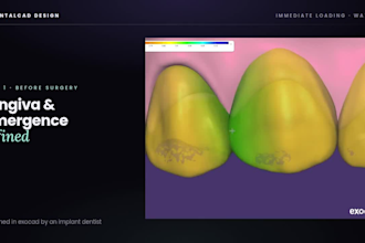 design your all on 4, all on x full arch implant bridge in exocad
