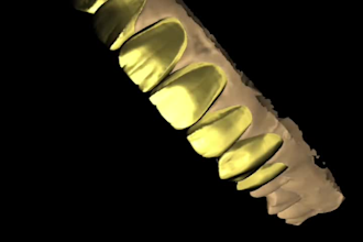 design wax up mock up and veneers using exocad