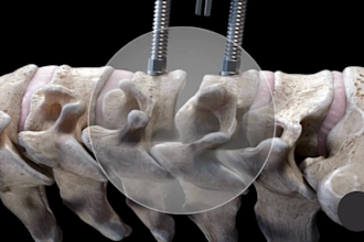 create 3d medical animation spine surgery anatomy implant procedure video