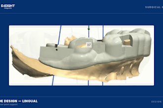 design a dental implant surgical guide in exoplan and 3shape