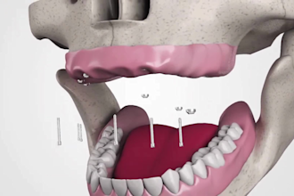 create 3d dental implant animation, patient education and oral surgery